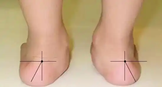 宝宝走路内八字怎么办三岁宝宝走路内八字怎么办