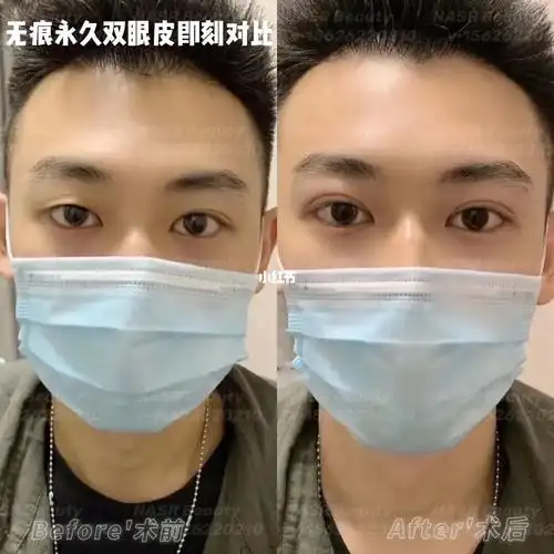 男士无痕永久双眼皮即刻对比75