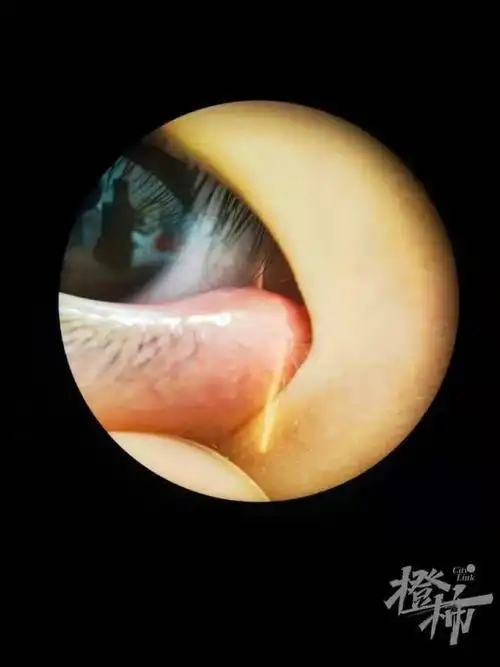 21岁大学女生睡前忘做这件事一觉醒来眼睛下方肿出了大号眼袋