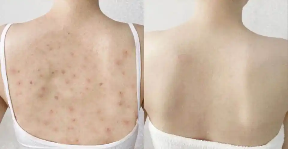 如果螨虫长在脸上背上,我们还是可以轻松发现的,因为它会让你变得