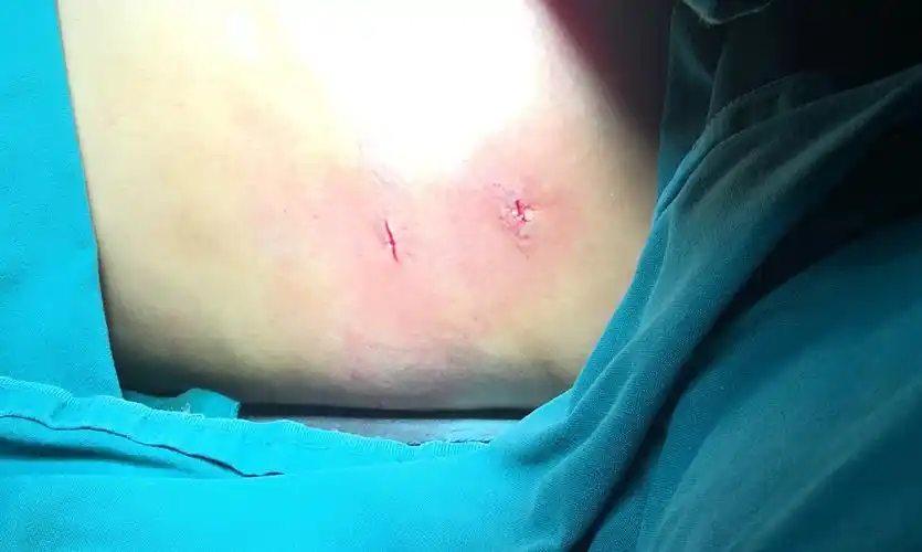 腋下两个约1cm切口