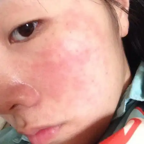 脸上反复过敏怎么回事 ——三,内分泌失调导致脸部过敏长期不良作息或