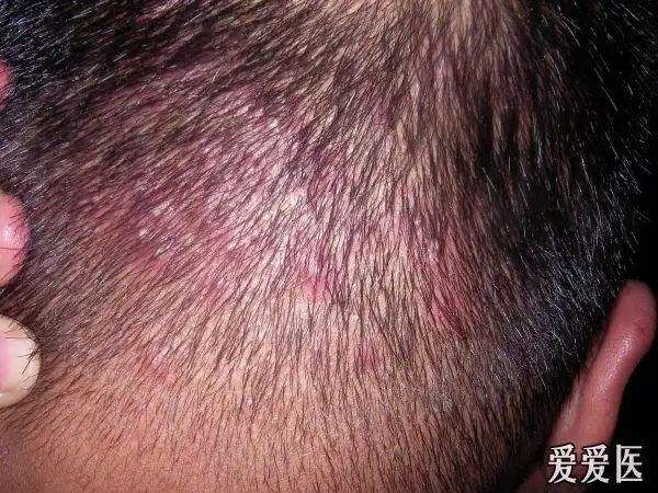 本人头部毛囊炎,求教