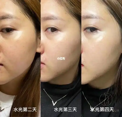 打完水光针原相机下的效果