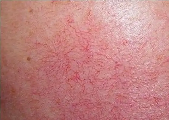 (原创)查看真相!什么是遗传性红血丝?