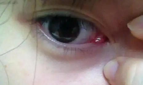 内眼角里面的肉肿(翻)起来是怎么回事