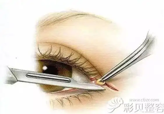 面诊后,杜院长说:我开外眼角失败的原因是手术方法不对,用的是传统一