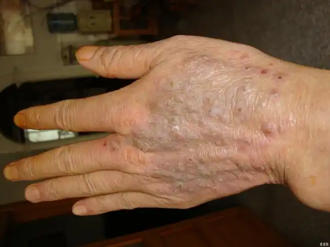 多年治疗治神经性皮炎的秘方 - 中医皮肤版 - 爱爱医医学论坛 - 爱爱