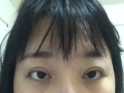 在他们家做的双眼皮 上睑肌无力提升,做了两次了,就这德行,然后不闻不