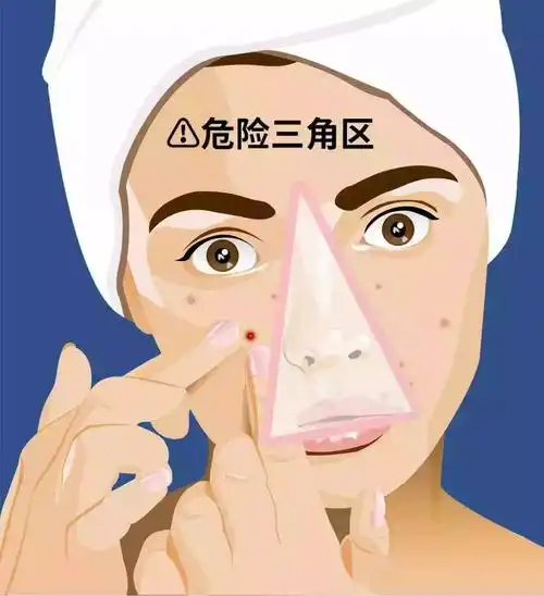 特别是三角区的痘痘,因为面部三角区深浅静脉分支相通且无瓣膜,挤痘会