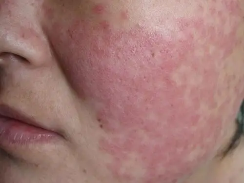 红斑狼疮是什么病图片