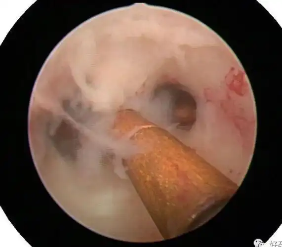 【妇科宫腔镜篇】宫腔镜下取环