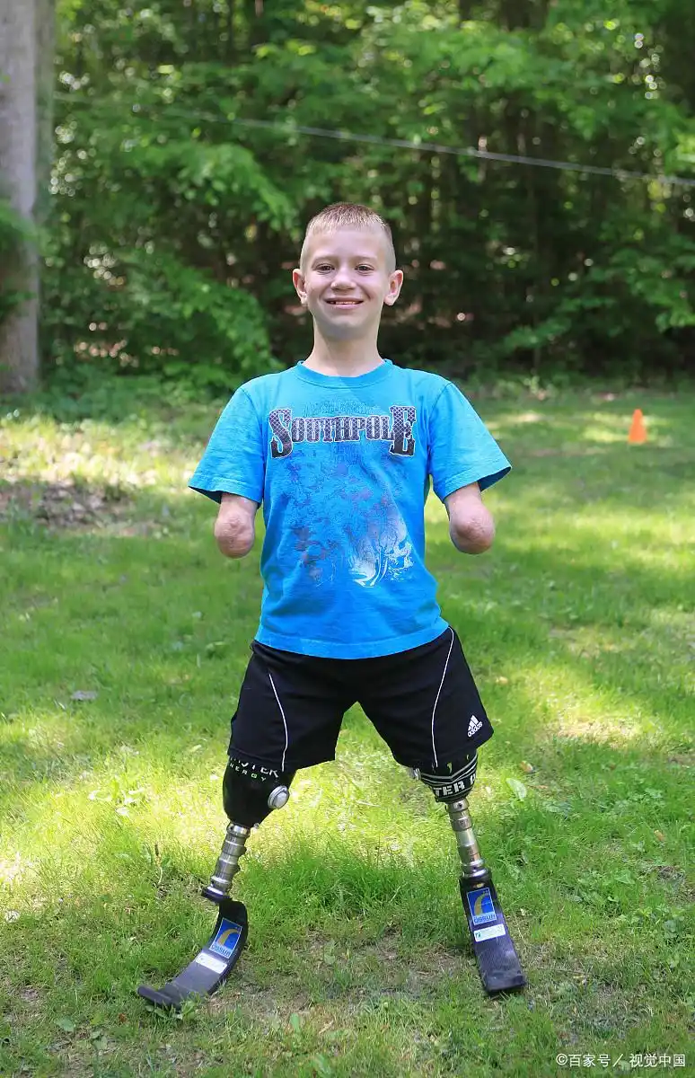 没有四肢的小孩不是重点,假肢以及他开朗乐观的态度才是重点