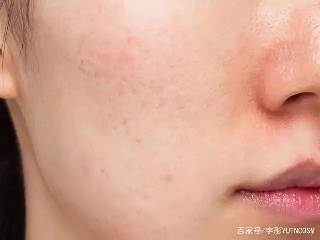 本色肤雕脸油毛孔粗大又爆痘该怎么管理
