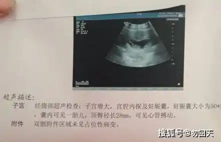 刚怀孕时,这2件事一定别做错了,小心影响到胎囊发育_胎儿_时候_营养