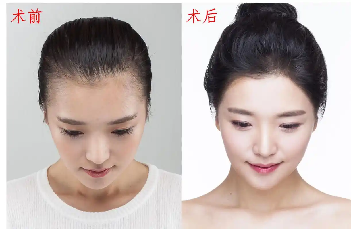 进阶女神你的发际线合格了吗