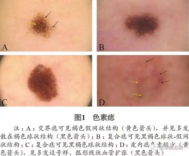 面部常见皮肤病皮肤镜诊断专家共识转载