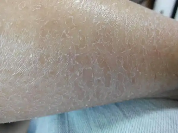 小腿干燥起皮掉屑