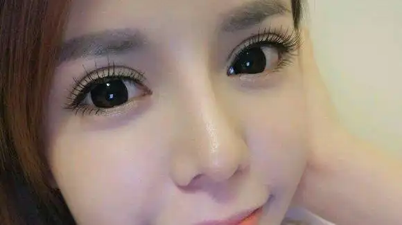 双眼皮平扇8mm外眼角3.5mm去皮提肌芭比眼案例分享