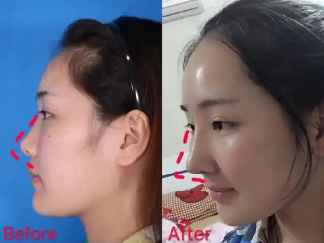 怎么才能让塌鼻子变高挺?
