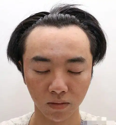 华晨宇最新素颜照曝光!满脸痘印,发际线超高