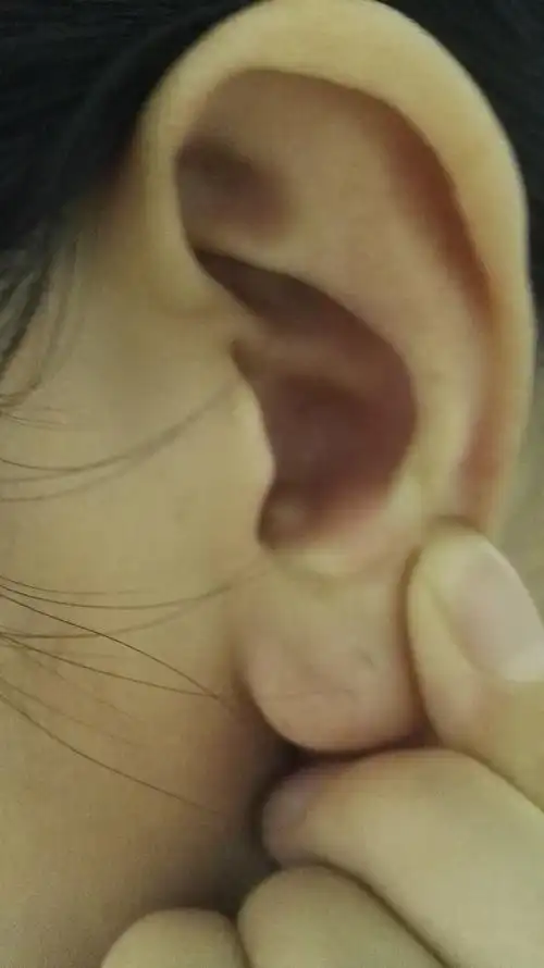 耳朵里边长了个白色的疙瘩一样的东西 很硬 掐都掐不动 有没有知道这