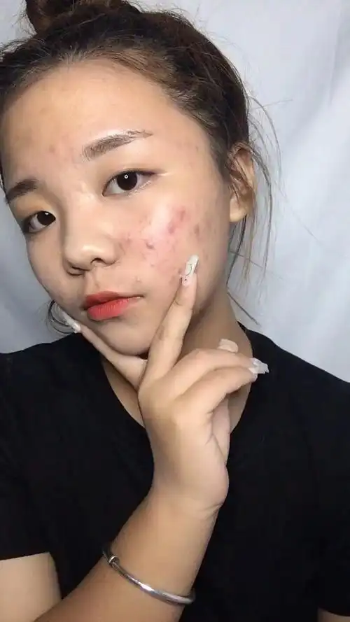 痘痘肌女孩的春天