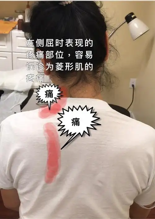 揭开肌筋膜整复手法的面纱一一斜角肌手法