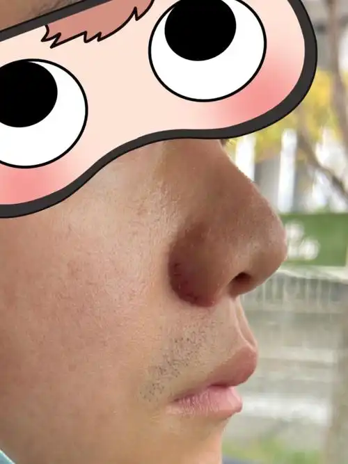 体验前变美诉求:鼻翼比较肥厚,看着很肉盾感,不精致_圈子-新氧美容