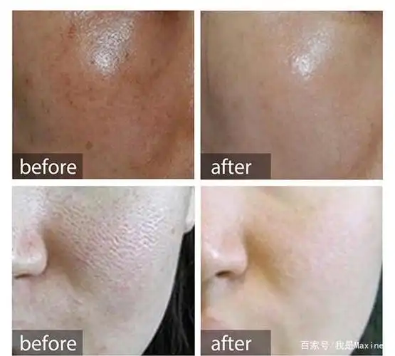 水光针改善前后皮肤状态对比