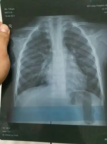 小孩四岁发烧不退诊断为肺炎,帮忙看下两次片子是否好了