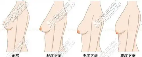 十七岁胸下垂怎么办网友支招怎么才可以改善或恢复