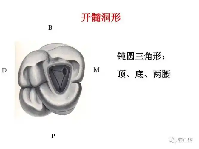 盘点磨牙开髓的方法