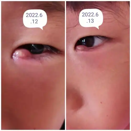 麦粒肿全程0药物