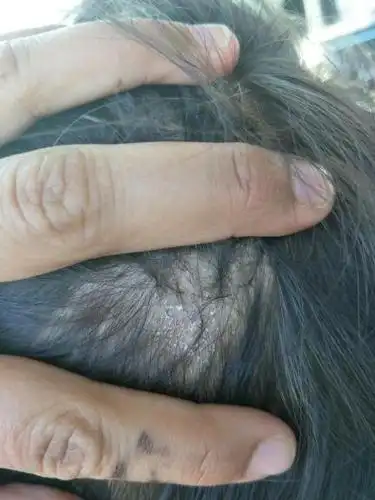 小孩头上有一个地方有白色皮屑,是癣吗?要怎么办