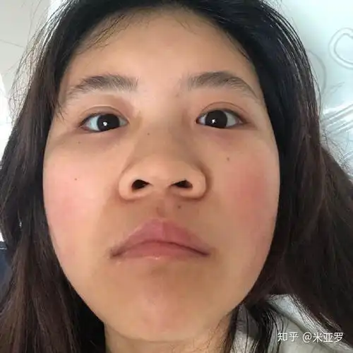 塌鼻子是大众脸,朝天鼻会拉低颜值,几种"丑鼻型"你中了吗?