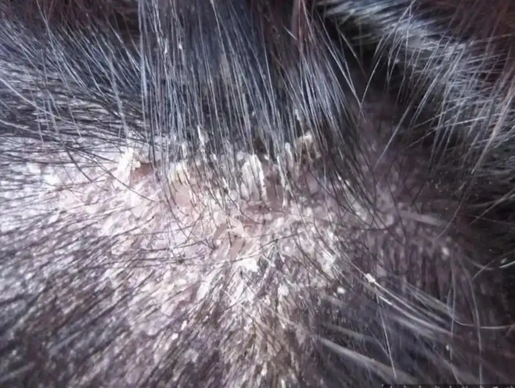 头皮银屑病,头皮像雪花一样这些治疗的坑80%的患者踩过  很多银屑病