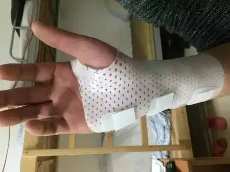正骨康复科引进新型材料:医用低温热塑板,骨折固定的新方式!