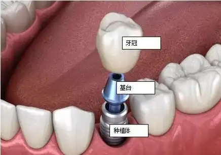 种植牙的基本流程,心中有数再去种牙-三六九医彩网 口腔行业数字化dso