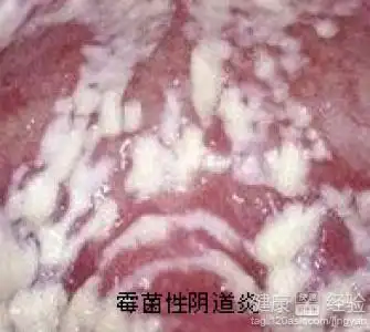 霉菌性外阴炎的治疗