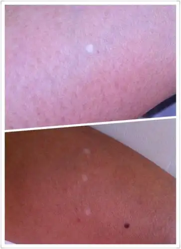 我手脚皮肤上,已经有两年了,皮肤上有白点,应该叫白斑吧?