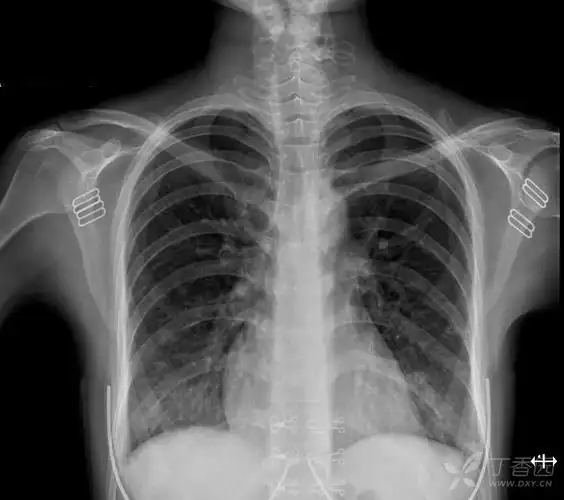 胸部影像挑战# 年轻女性肩痛 1 月,咳嗽 4 天,入院体温 39.9°c.