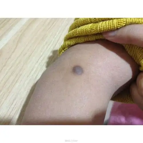 皮肤纤维瘤一例