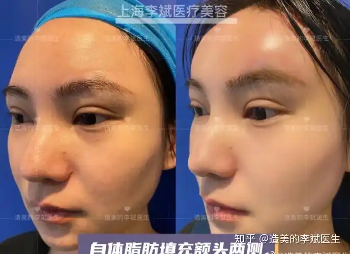 脂肪填充=寿星公风格?那是因为审美和技术问题!