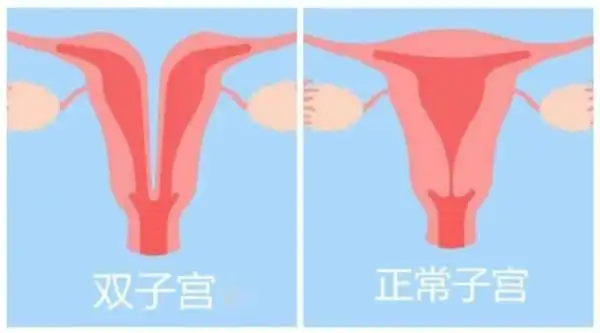 25岁女子体内竟有2个子宫,怀孕时她慌了!医生说