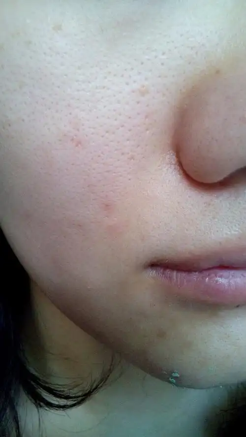 毛孔大的已经毁容了,有图有真相.有没有人能救.