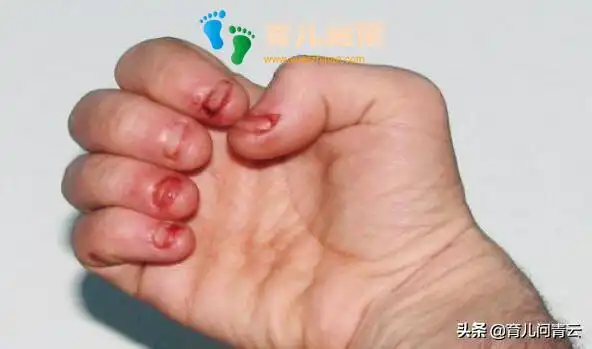 孩子总咬指甲真正的原因在这里