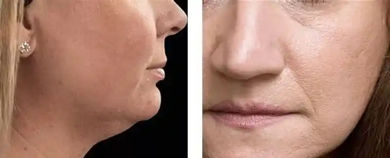 苹果肌下移,法令纹,双下巴等都是面部高级松弛的症状,一旦出现那你