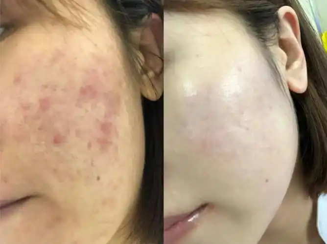 植萃肌密救了我的烂皮肤,给大家分享我的治痘经历!