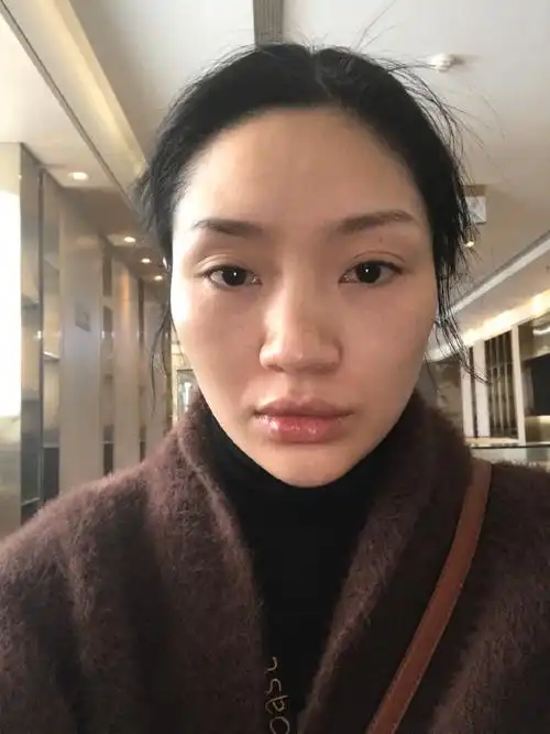 肥大还特别难看鼻梁也不高还有鼻翼宽鼻头大我爸爸到长了个好看鼻子